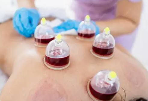 Wet Cupping Therapy